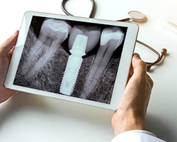 X-ray of dental implant after bone grafting in Carrollton