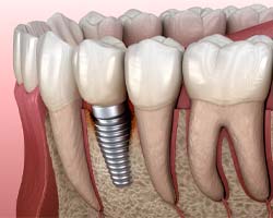 Dental implant in Carrollton