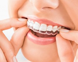 Nose-to-chin closeup of woman placing Invisalign over upper arch