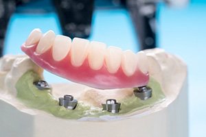 Denture resting on top of dental implants that are set into a wax model