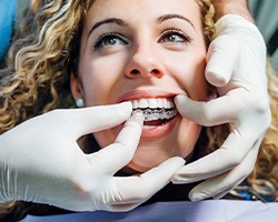 Dentist’s gloved hands inserting Invisalign over woman’s upper arch