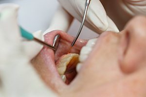 a close-up of a dentist using a soft tissue laser