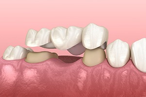 Dental bridge in Carrollton