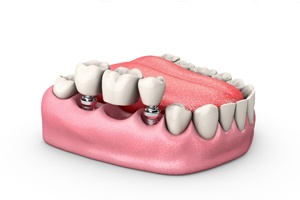 An implant-retained bridge