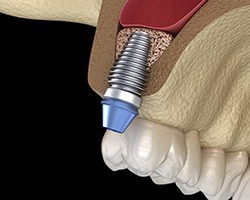 Diagram of dental implant after sinus lift in Carrollton