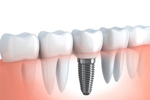 Diagram of how dental implants in Carrollton work