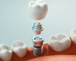 Diagram of parts of dental implants in Carrollton