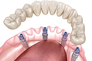 Digital illustration of all-on-4 dental implants