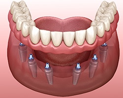A digital image of an implant denture sitting on the lower arch of the mouth in Carrollton