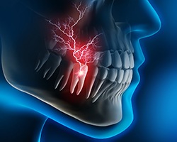 X-ray diagram of toothache in Carrollton