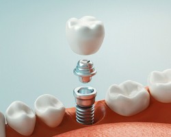 Dental implant bridge in Carrollton