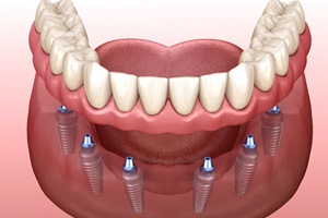 diagram of fixed implant dentures in Carrollton