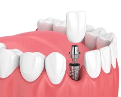 Dental implant in Carrollton