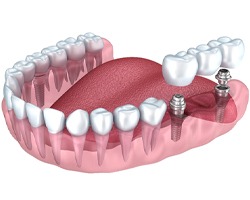 Implant bridge in Carrollton