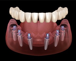 Implant denture in Carrollton