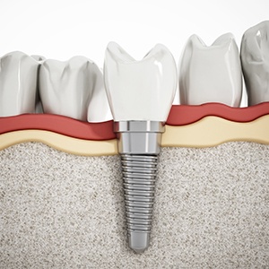 Animation of implant supported dental crown
