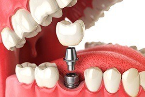 Animation of dental implant placement