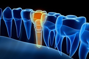 Animation of smile with implant crown
