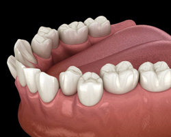 Digital image of crowded teeth 