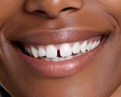 Person’s smile with gap between their front teeth 