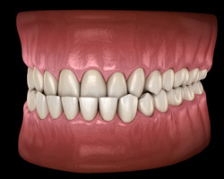 Digital image of an underbite 