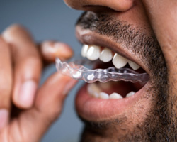 Man inserting a clear aligner 