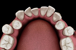 Illustration of gapped teeth