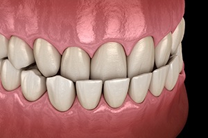 Illustration of an overbite