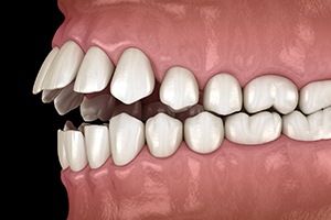 Illustration of an open bite
