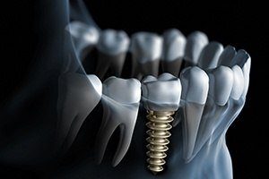 Animation of implant supported dental crown