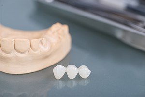 Model smile and fixed bridge restoration