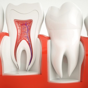 Model of teeth showing the inside of the root canal