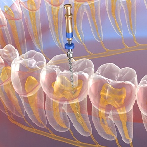 Illustration of process for root canal therapy in Carrollton, TX