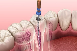 Illustration of root canal therapy in Carrolton, TX for lower teeth