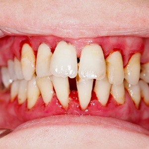A mouth with significant gum disease.