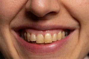 A close-up of a person with stained teeth 