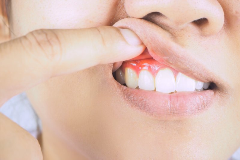 a person holding up their top lip to expose red, inflamed gum tissue
