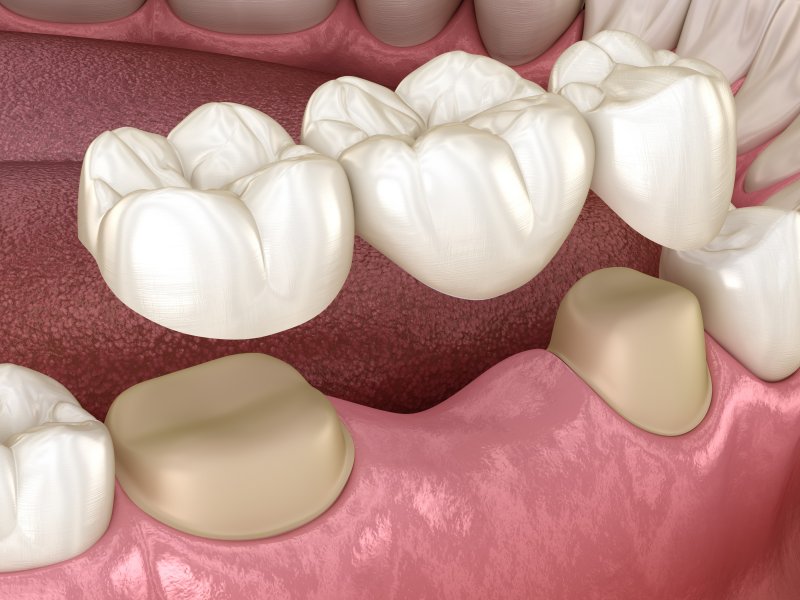 a digital image of a dental bridge in Carrollton