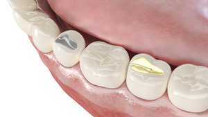 3D render of dental fillings