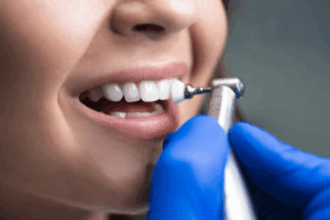 Close up of a dentist polishing a patient’s teeth